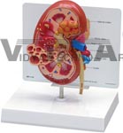 Oversize Diseased Kidney Anatomy Model with Patient Education Card